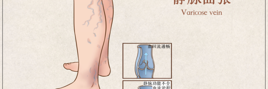 告別“蚯蚓腿”，靜脈曲張怎么調(diào)？