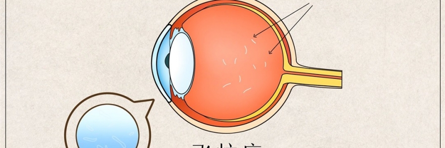 “蚊子”在眼里飛？這類人要注意了！