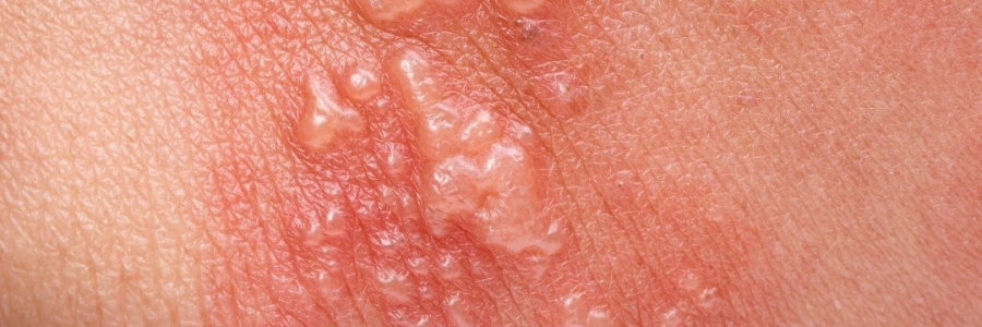 艾灸后起了小水泡，居然是邪氣在“逃跑”！