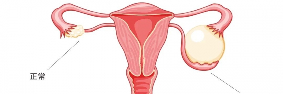 太神奇了，艾灸調(diào)好了她的卵巢囊腫！